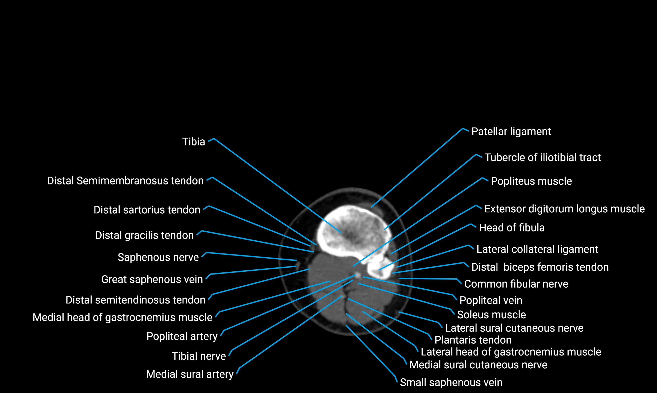 CT lower limb axial cross sectional anatomy labelled image 95 (2).webp